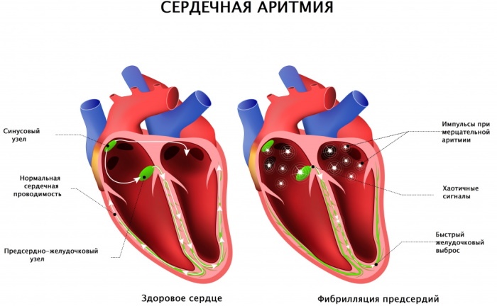 Гипертония 1 степени. Симптомы и лечение, препараты