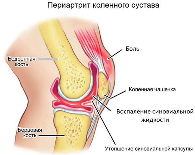 Периартрит коленного сустава. Симптомы и лечение сухожилий