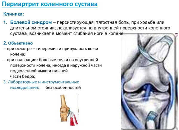 Периартрит коленного сустава. Симптомы и лечение сухожилий