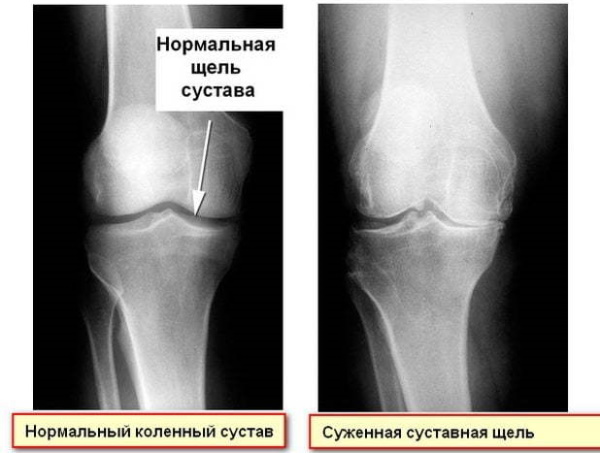 Периартрит коленного сустава. Симптомы и лечение сухожилий