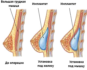 Почему у женщин маленькая грудь. Причины