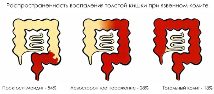 Проктосигмоидит. Симптомы и ощущение болей, лечение