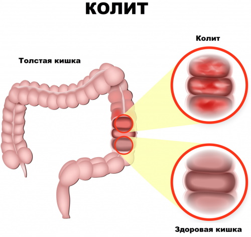 Проктосигмоидит. Симптомы и ощущение болей, лечение