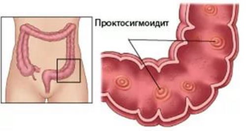 Проктосигмоидит. Симптомы и ощущение болей, лечение