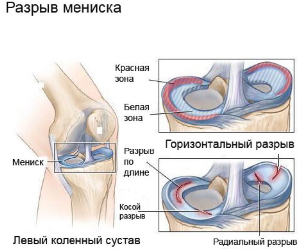 Разрыв мениска коленного сустава. Симптомы и лечение