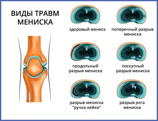 Разрыв мениска коленного сустава. Симптомы и лечение