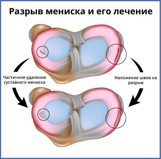 Разрыв мениска коленного сустава. Симптомы и лечение