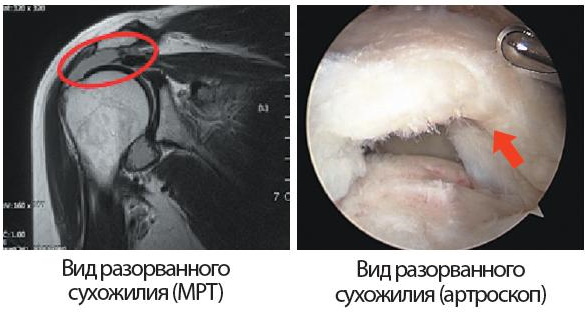 Разрыв сухожилия надостной мышцы плечевого сустава