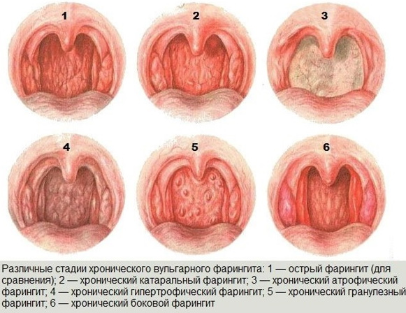 Ринофарингит у взрослых. Симптомы, лечение