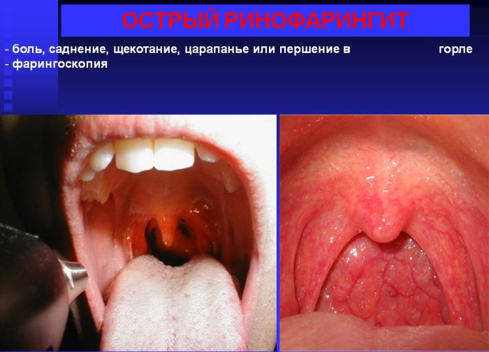 Ринофарингит у взрослых. Симптомы, лечение