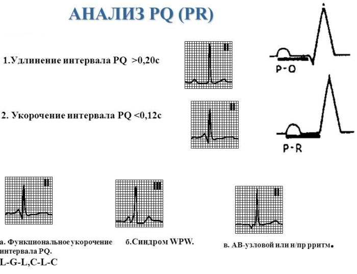 Укорочение PQ на ЭКГ. Что это значит