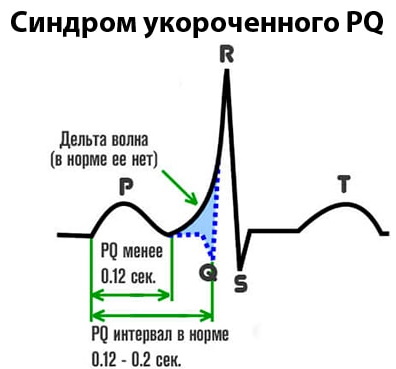 Укорочение PQ на ЭКГ. Что это значит