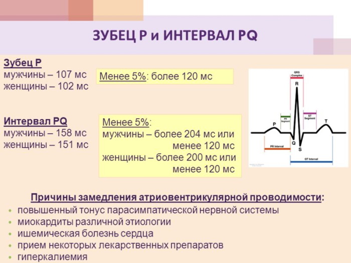 Укорочение PQ на ЭКГ. Что это значит