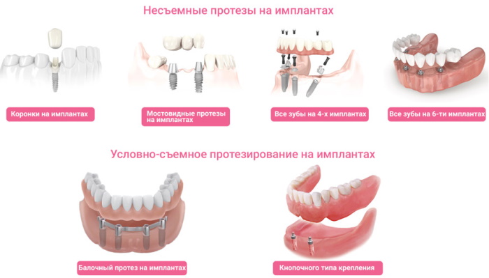 Условно-съемный протез на имплантах на верхнюю, нижнюю челюсть. Цена