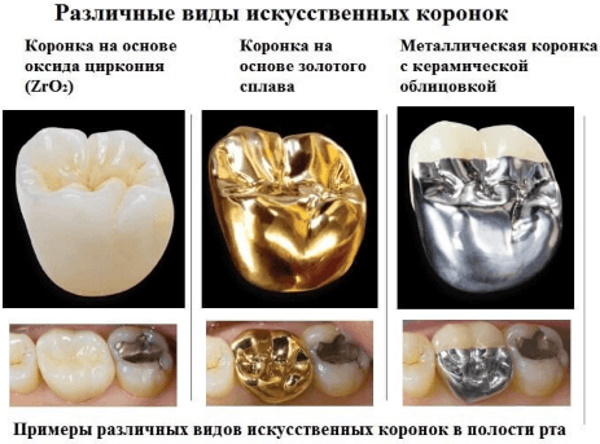 Коронки для зубов. Виды, какие лучше, плюсы, минусы, цены