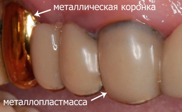 Коронки для зубов. Виды, какие лучше, плюсы, минусы, цены