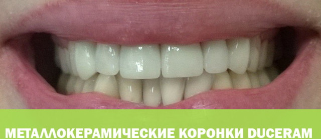 Коронки для зубов. Виды, какие лучше, плюсы, минусы, цены