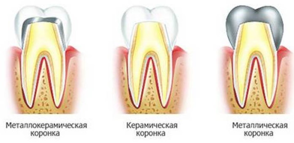 Коронки для зубов. Виды, какие лучше, плюсы, минусы, цены