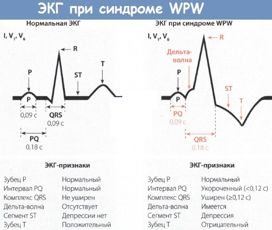 Как прочитать электрокардиограмму сердца самому. Расшифровка ЭКГ