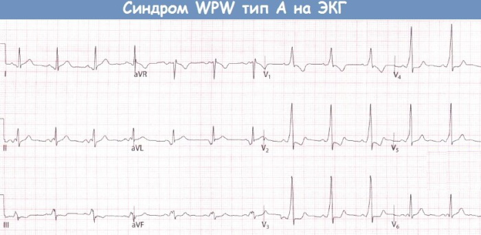 Синдром wpw карта вызова
