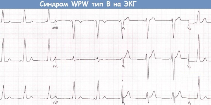 Синдром впв на экг фото