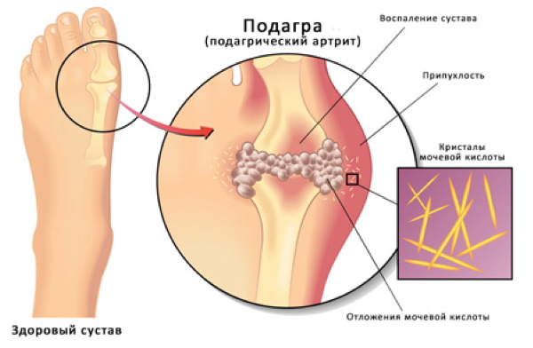 Жжение в ногах ниже колена. Причины и лечение