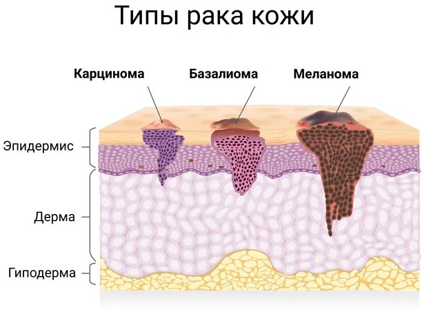 Базалиома на ноге фото