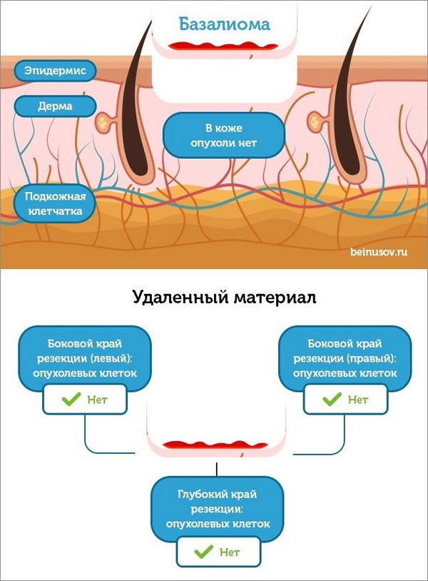 Базалиома на носу. Фото, лечение, цитологическая картина