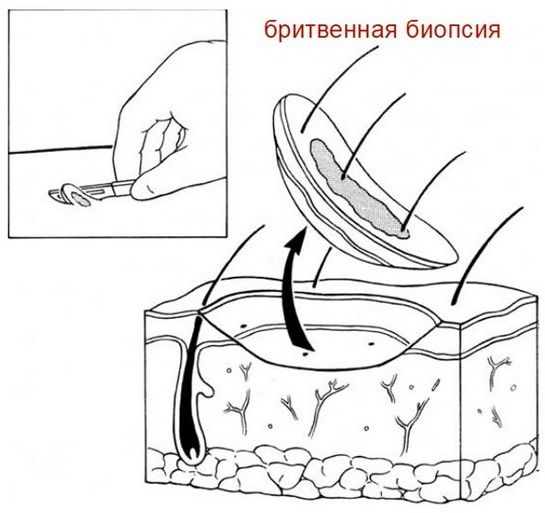 Базалиома на носу. Фото, лечение, цитологическая картина