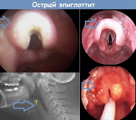 Болезни горла и гортани. Фото и описание, симптомы