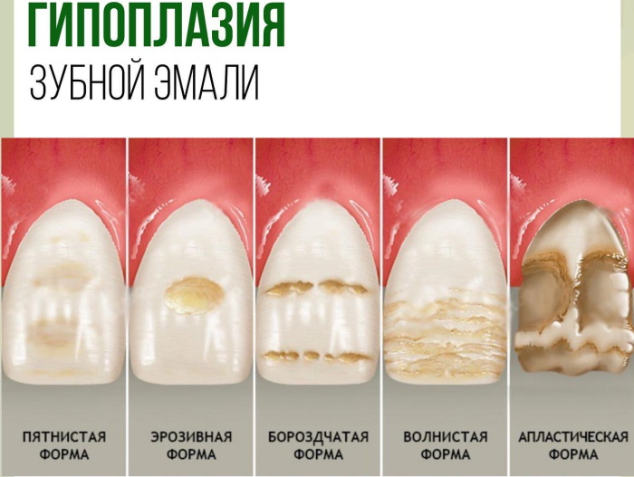 Как убрать черные полосы на зубах у ребенка