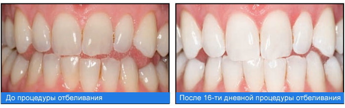 Домашнее отбеливание зубов с капами. Отзывы, цена
