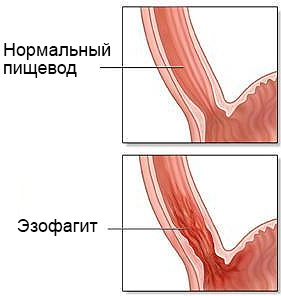 Эзофагит. Симптомы и лечение медикаментозное, диета