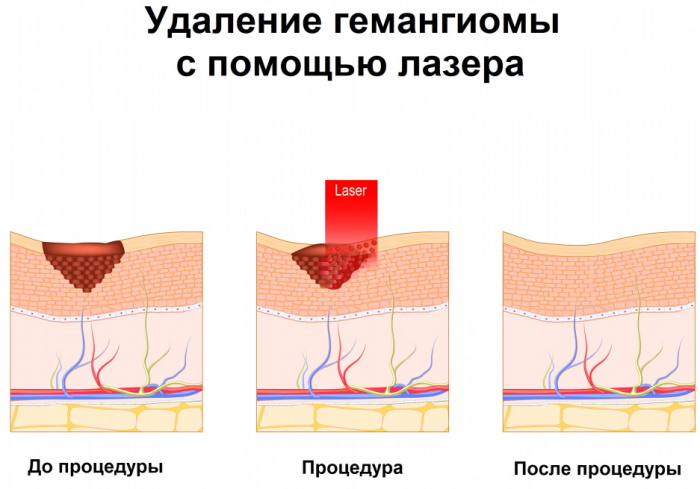 Гемангиома на коже. Фото, УЗИ, описание