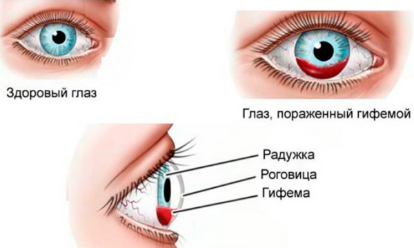 Глазные капли при кровоизлиянии в глазу от давления