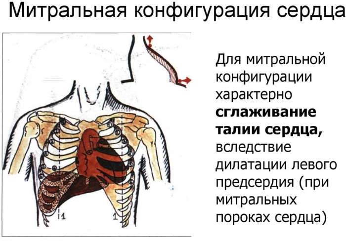 Конфигурация сердца в норме, при патологии