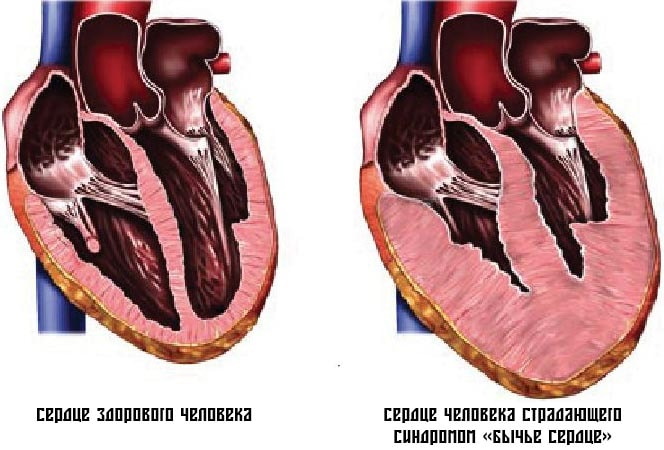 Конфигурация сердца в норме, при патологии