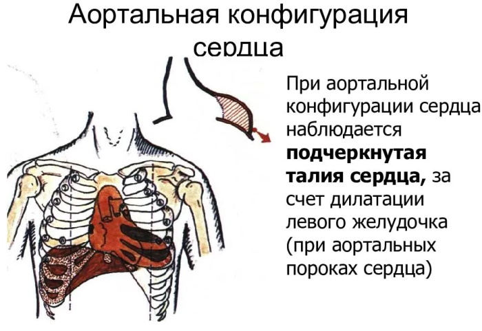 Конфигурация сердца в норме, при патологии