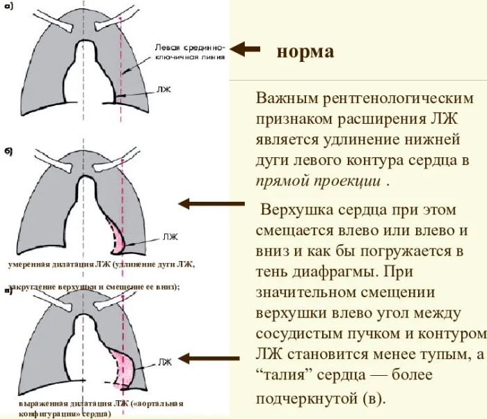 Конфигурация сердца в норме, при патологии