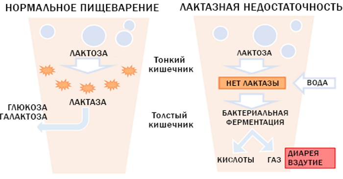 Лактазная недостаточность у взрослых. Симптомы, диагностика