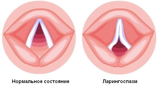 Ларингоспазм у взрослых. Симптомы и лечение