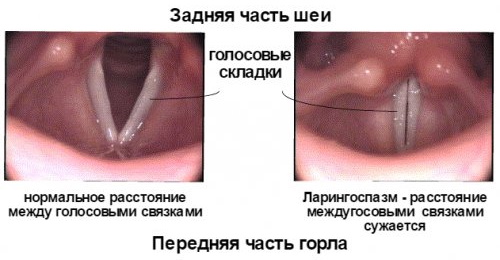 Ларингоспазм у взрослых. Симптомы и лечение