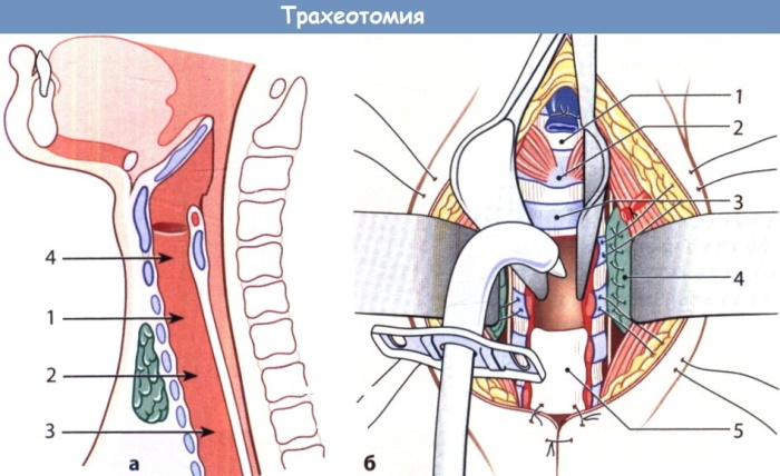 Ларингоспазм у взрослых. Симптомы и лечение