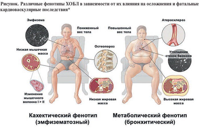 Обострение хронического бронхита. Лечение, симптомы