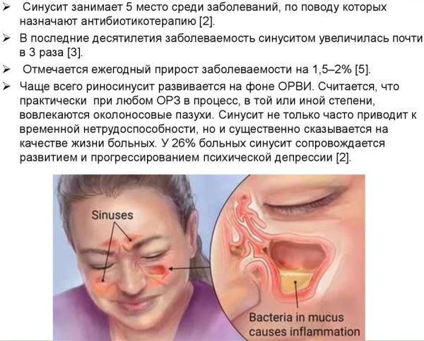 Острый риносинусит у взрослых. Симптомы и лечение