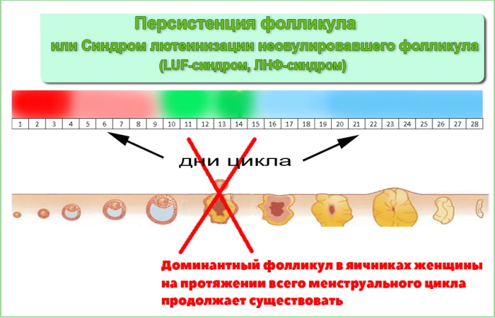 Персистенция фолликула правого яичника. Что это такое