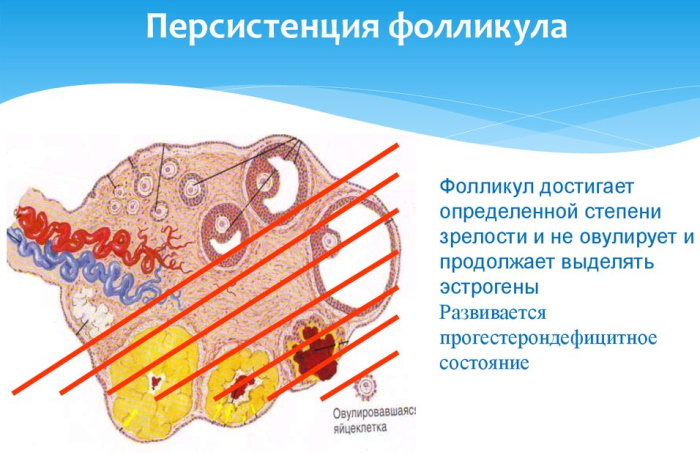 Персистенция фолликула правого яичника. Что это такое