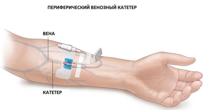 Постановка периферического катетера. Алгоритм, уход