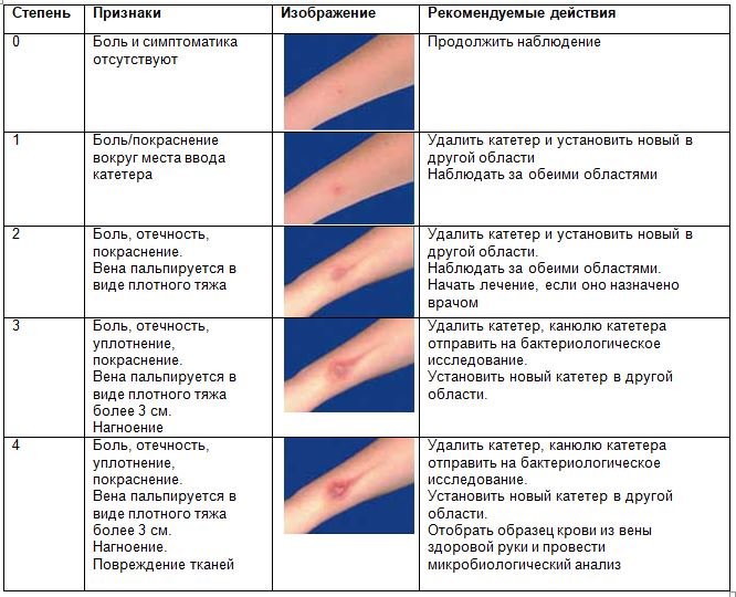 Постановка периферического катетера. Алгоритм, уход