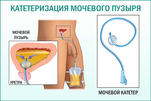 Постановка периферического катетера. Алгоритм, уход